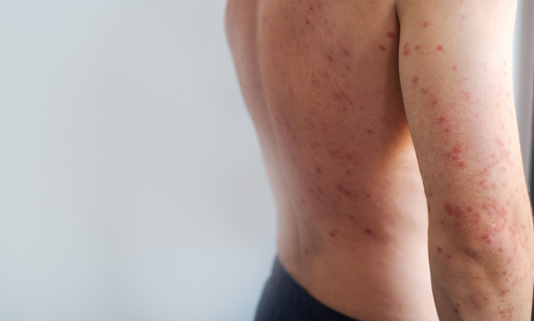 Man with many blisters on body some drying and forming crusts typical signs of adult chickenpox infection